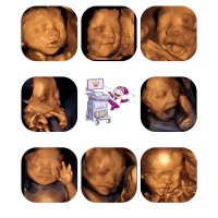 胎儿系统超声检查（四维彩超）很重要，孕妈不能只关注照片的清晰度